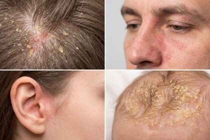 Seborrheic Dermatitis: Causes, Symptoms, and Treatment