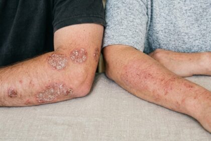 Psoriasis vs Eczema: Key Differences, Symptoms, and How to Tell Them Apart