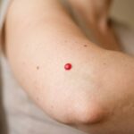 Cherry Angiomas Causes: What They Are and When to Worry
