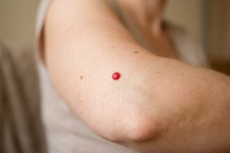 Cherry Angiomas Causes: What They Are and When to Worry