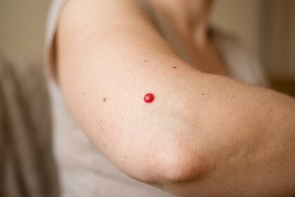 Cherry Angiomas Causes: What They Are and When to Worry