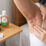 Hidradenitis Suppurativa Symptoms: Early Signs, Stages, and Treatment