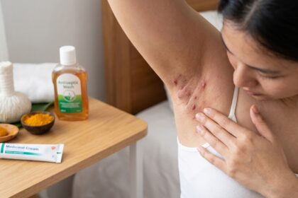 Hidradenitis Suppurativa Symptoms: Early Signs, Stages, and Treatment